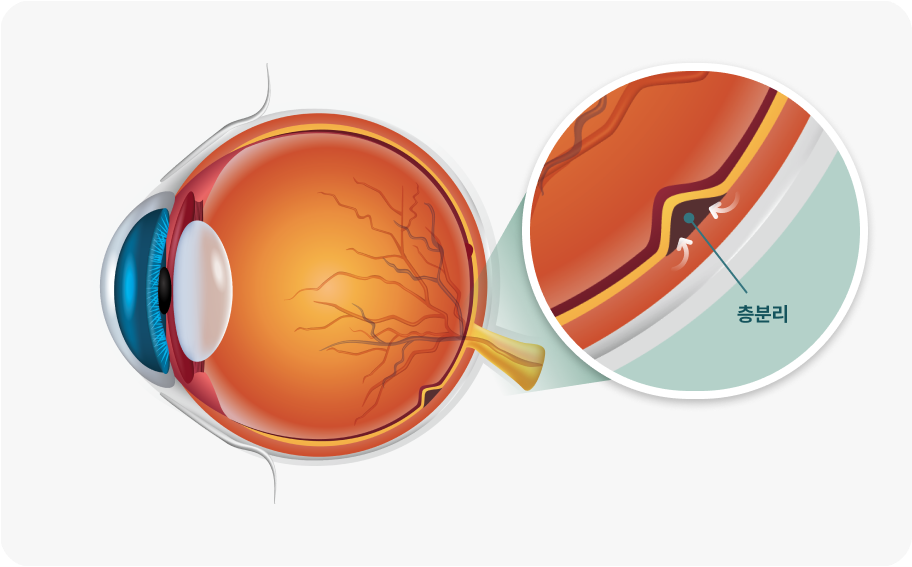 중심성장액망막병증이란?