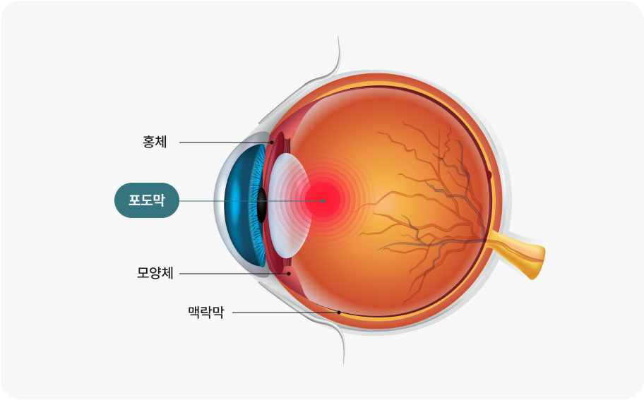 포도막염이란?