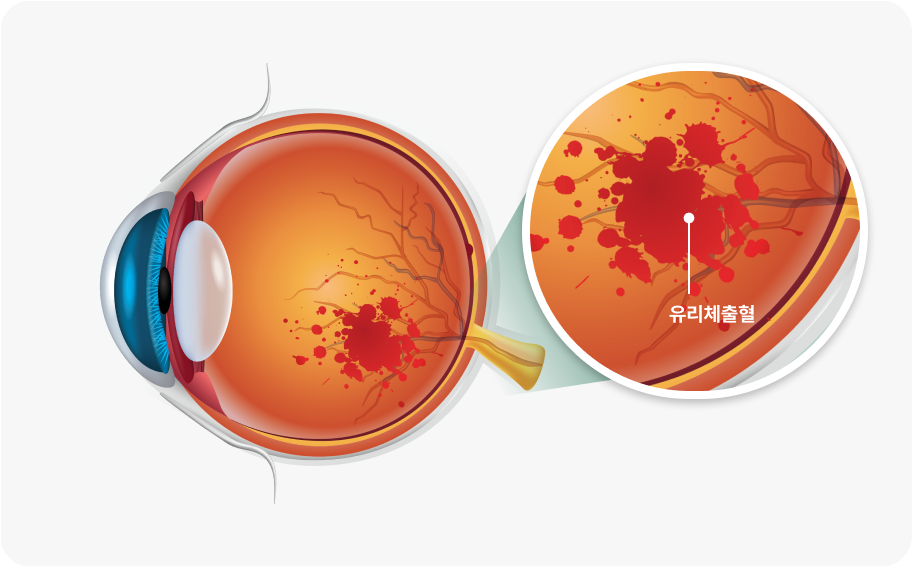 유리체출혈이란?